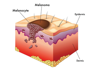 Mole - natural formation which can be eliminated by using Skincell Pro