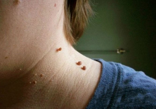 papillomas of the neck