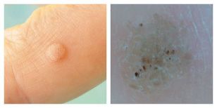 Frequent wart on examination and dermatoscopy