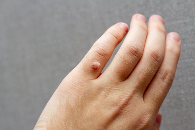 a wart on a finger